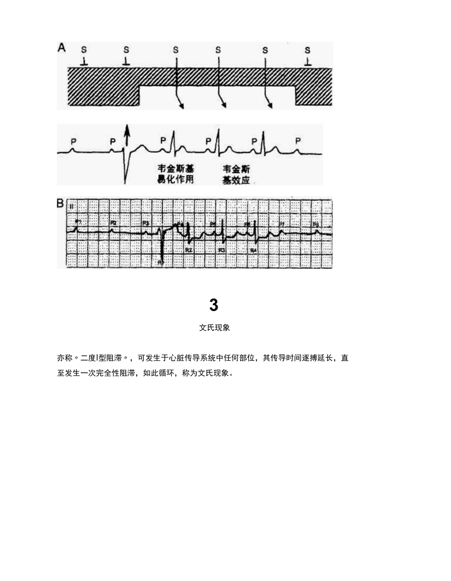 常见异常心电现象大汇总.docx_第2页