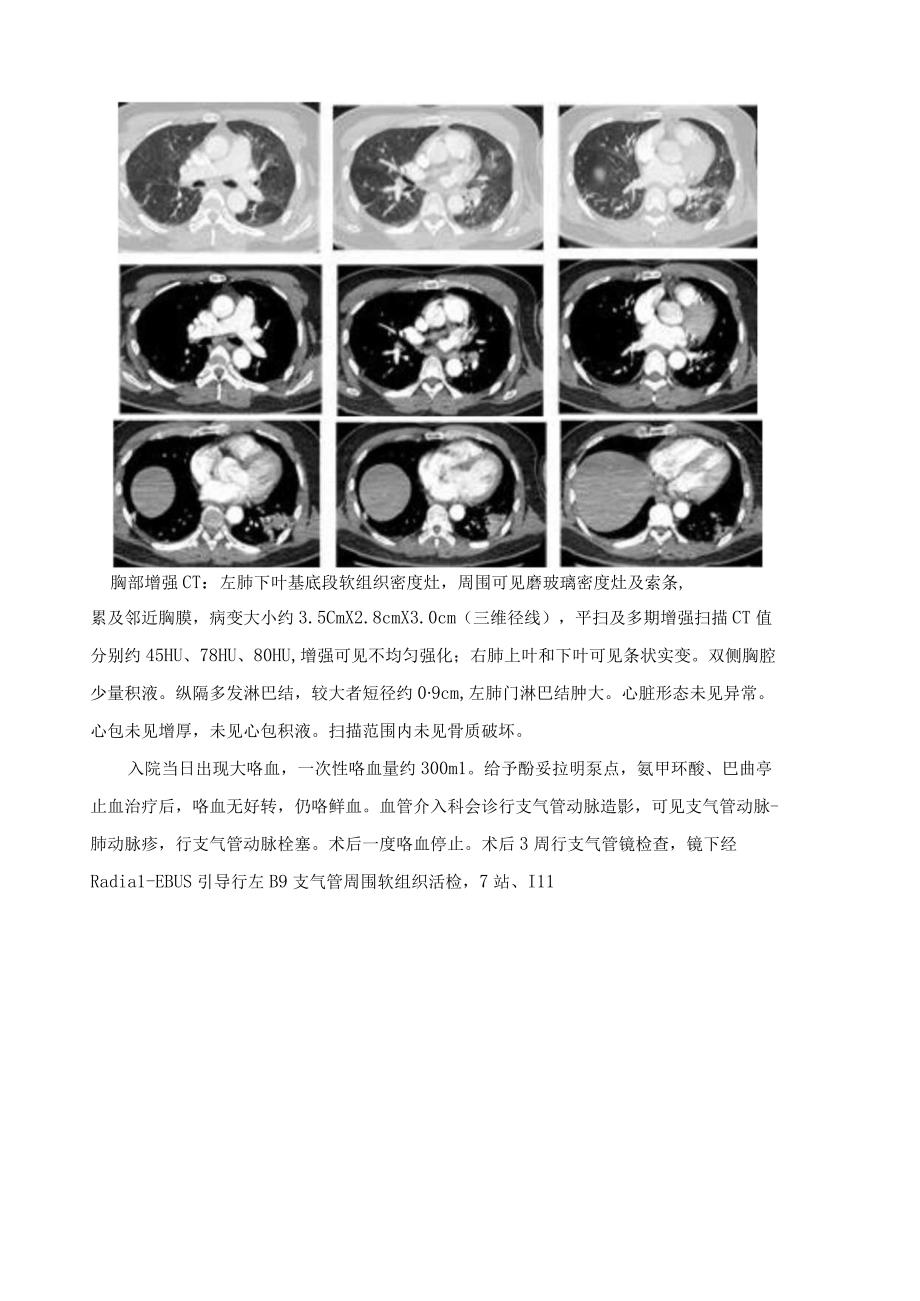 肺放线菌病临床思维训练.docx_第2页