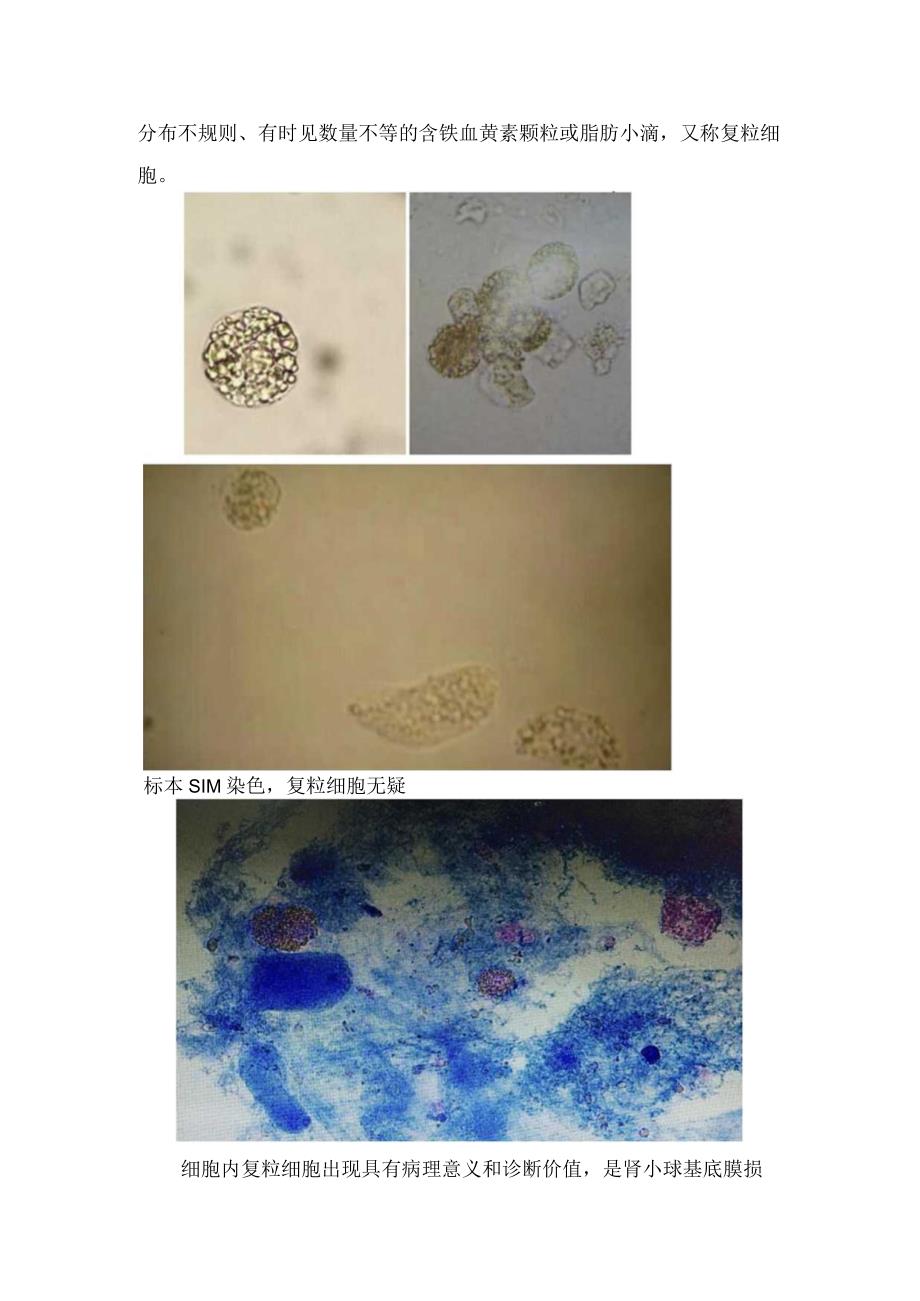 肾病综合诊断标准检验显微镜显示及复粒细胞.docx_第2页