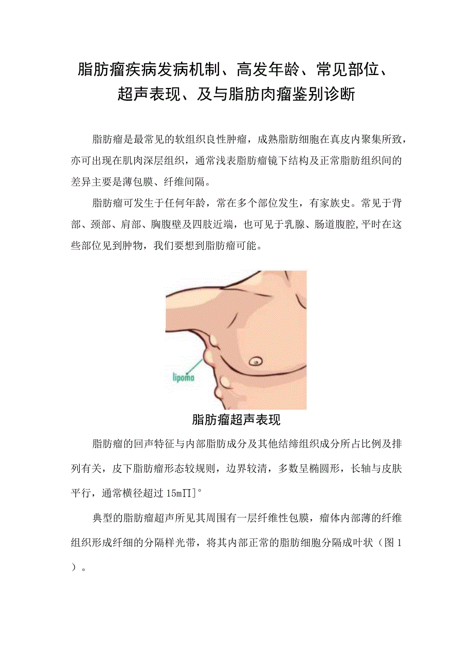 脂肪瘤疾病发病机制高发年龄常见部位超声表现及与脂肪肉瘤鉴别诊断.docx_第1页