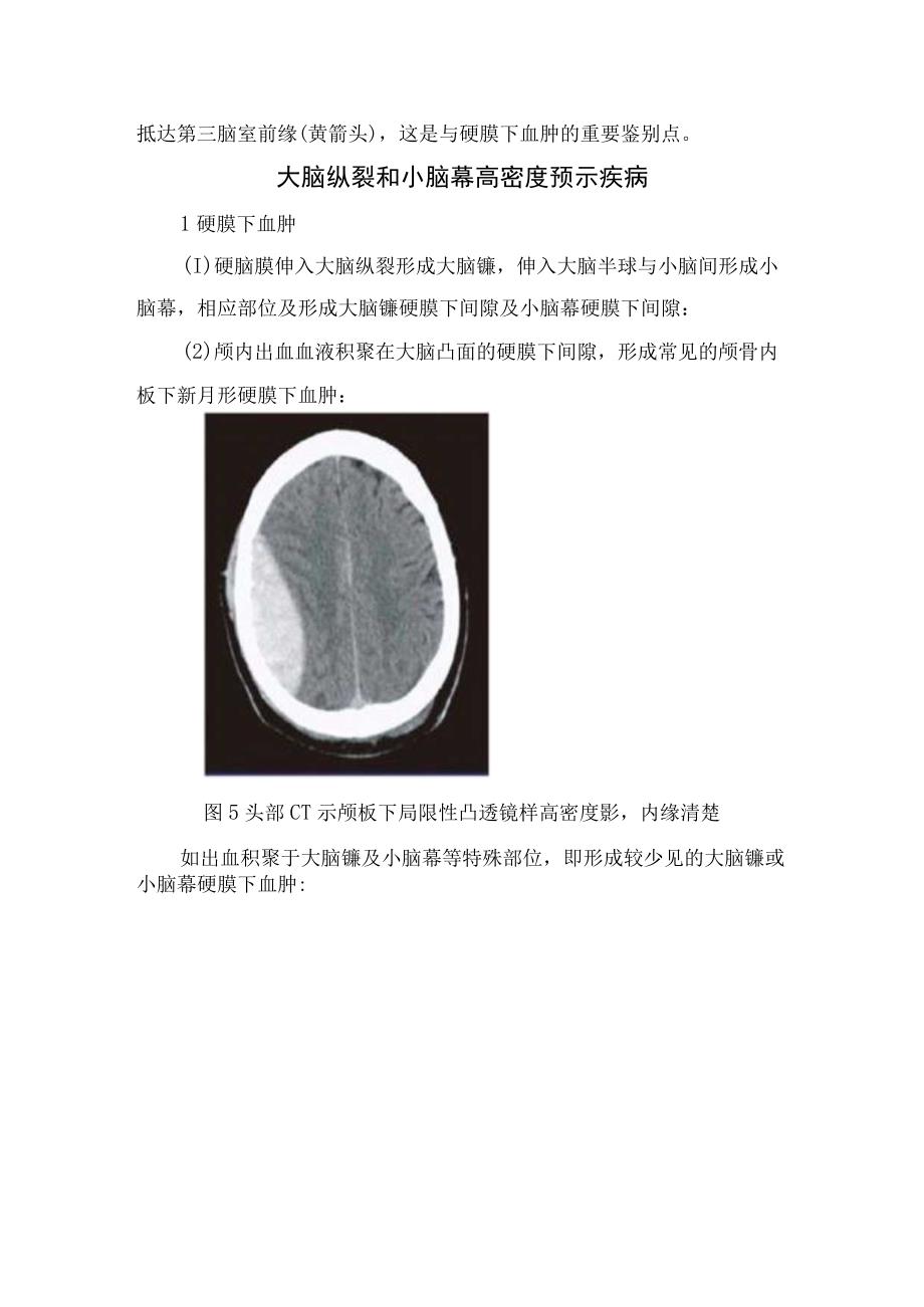 蛛网膜硬脑膜大脑镰及小脑幕等解剖结构影像学表现及蛛网膜下腔出血硬膜下血肿诊断和鉴别诊断.docx_第3页