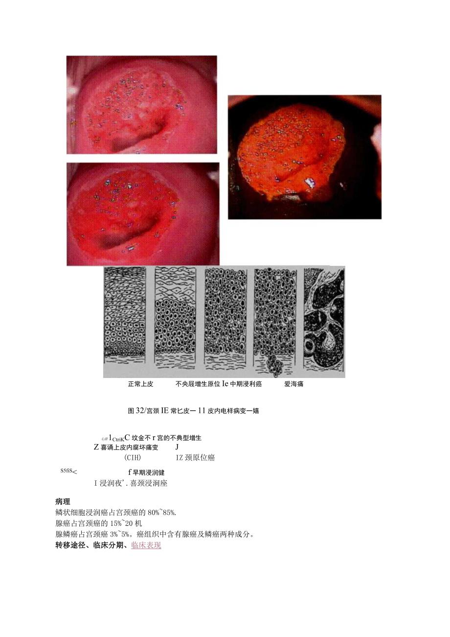 中西医结合妇科学女性生殖器官肿瘤课程讲义及练习.docx_第3页