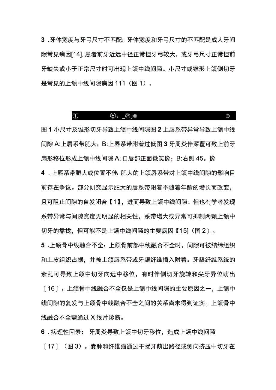 2023局部瓷贴面治疗上颌中线间隙的临床要点.docx_第3页