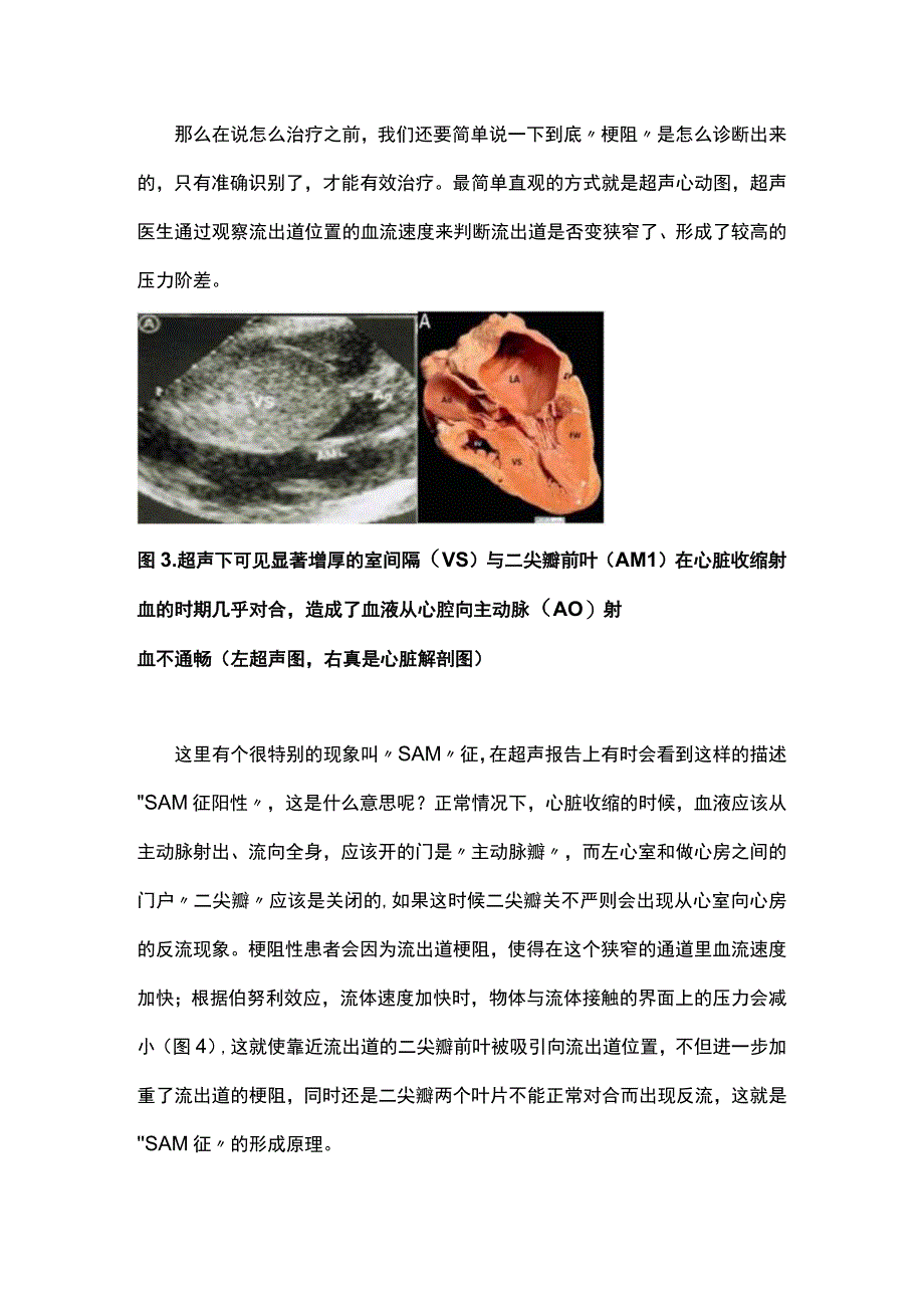 2023梗阻性肥厚型心肌病诊疗方法汇总全文.docx_第3页