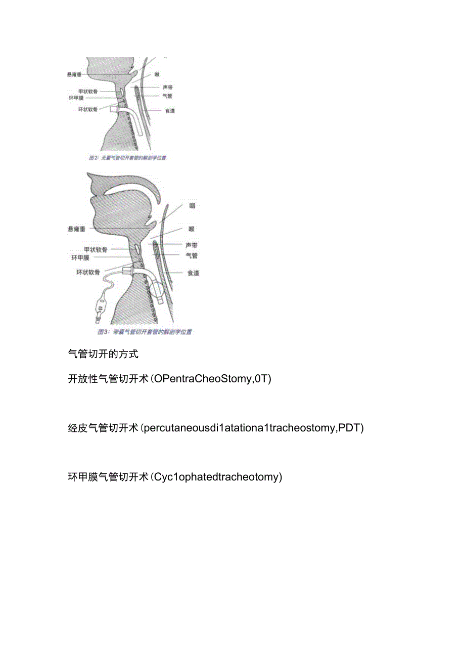 2023气管切开和经皮气管切开术全文.docx_第3页