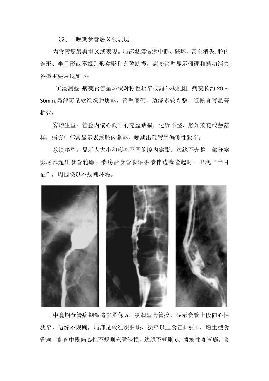 临床食管癌病理临床表现影像学表现及鉴别诊断.docx_第2页