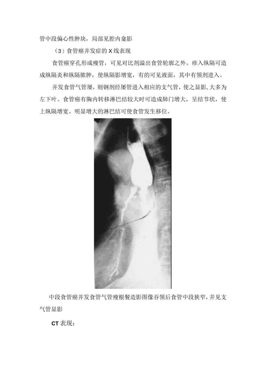 临床食管癌病理临床表现影像学表现及鉴别诊断.docx_第3页