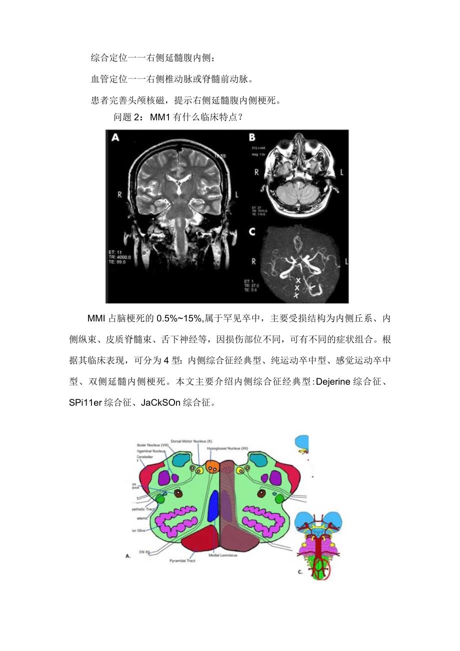 临床Dejerine综合征Spiller综合征Jackson综合征等经典延髓内侧综合征病例分享症状定位定性临床特点及表现不同.docx_第2页