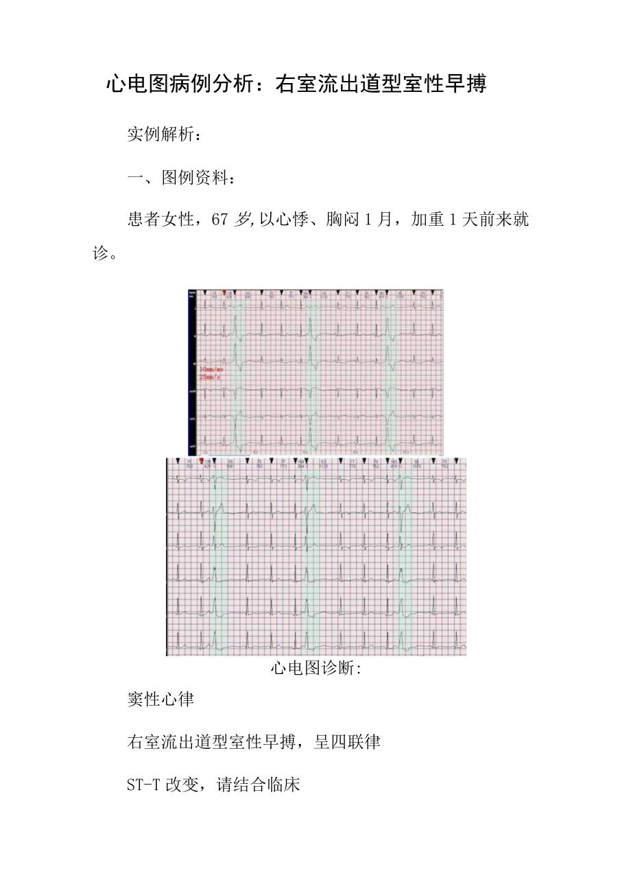 心电图医师晋升副主任（主任）医师高级职称病例分析专题报告（右室流出道型室性早搏）.docx_第2页