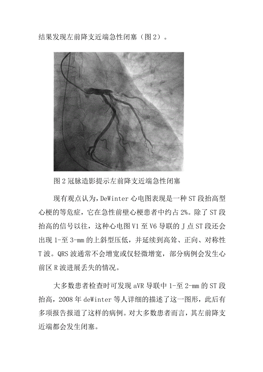 心电图室医师晋升副主任（主任）医师高级职称病例分析专题报告（罕见但却致命的De Winter综合征）.docx_第3页