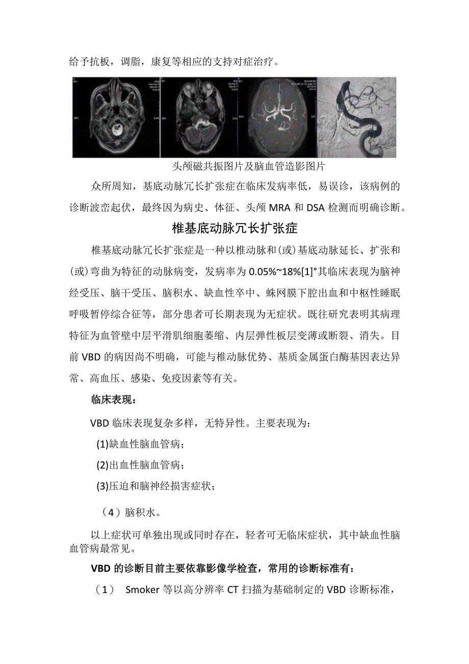 椎基底动脉冗长扩张症病例分享、病理机制、临床表现、鉴别诊断及治疗.docx_第3页