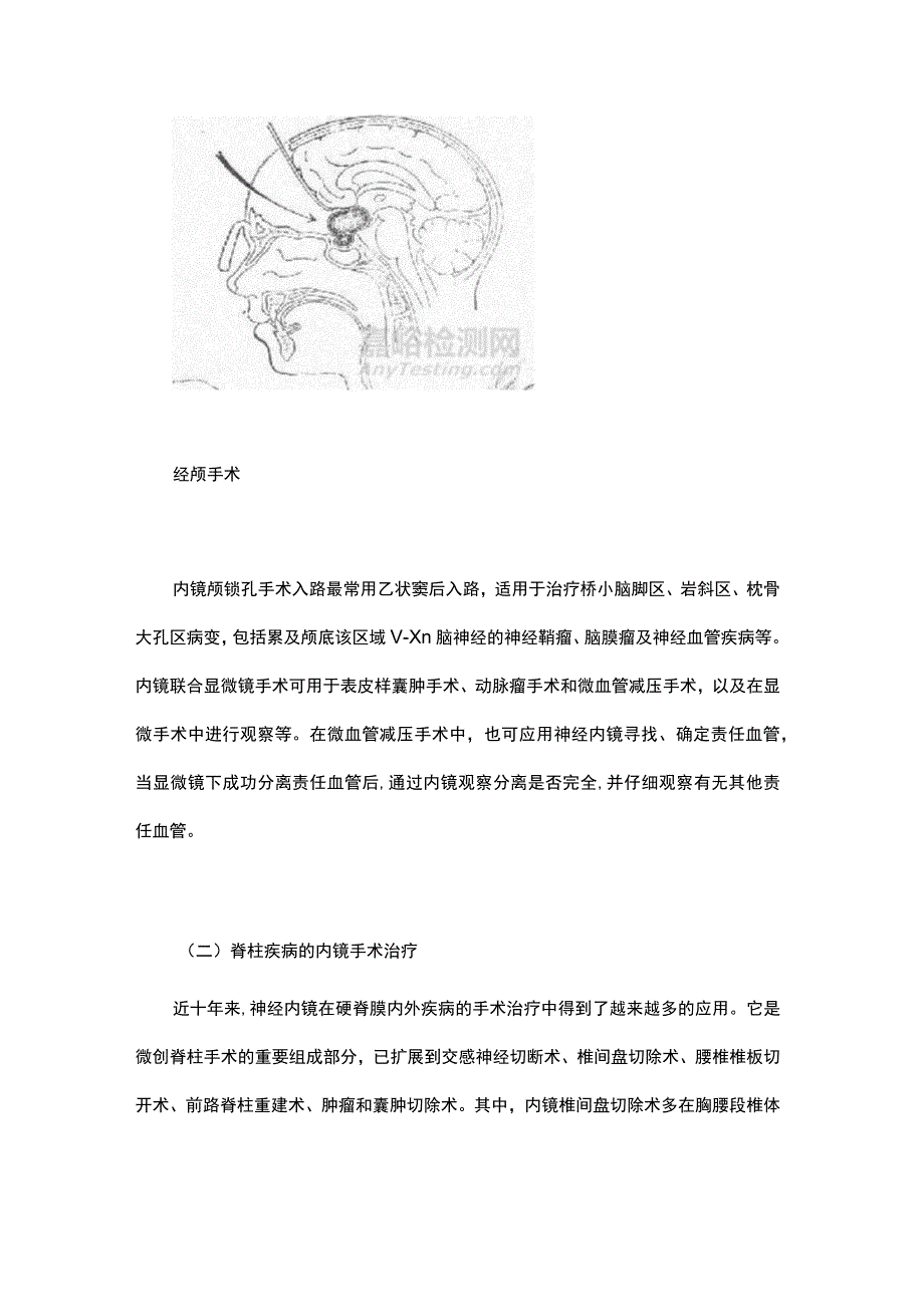 神经内窥镜手术的来龙去脉.docx_第3页