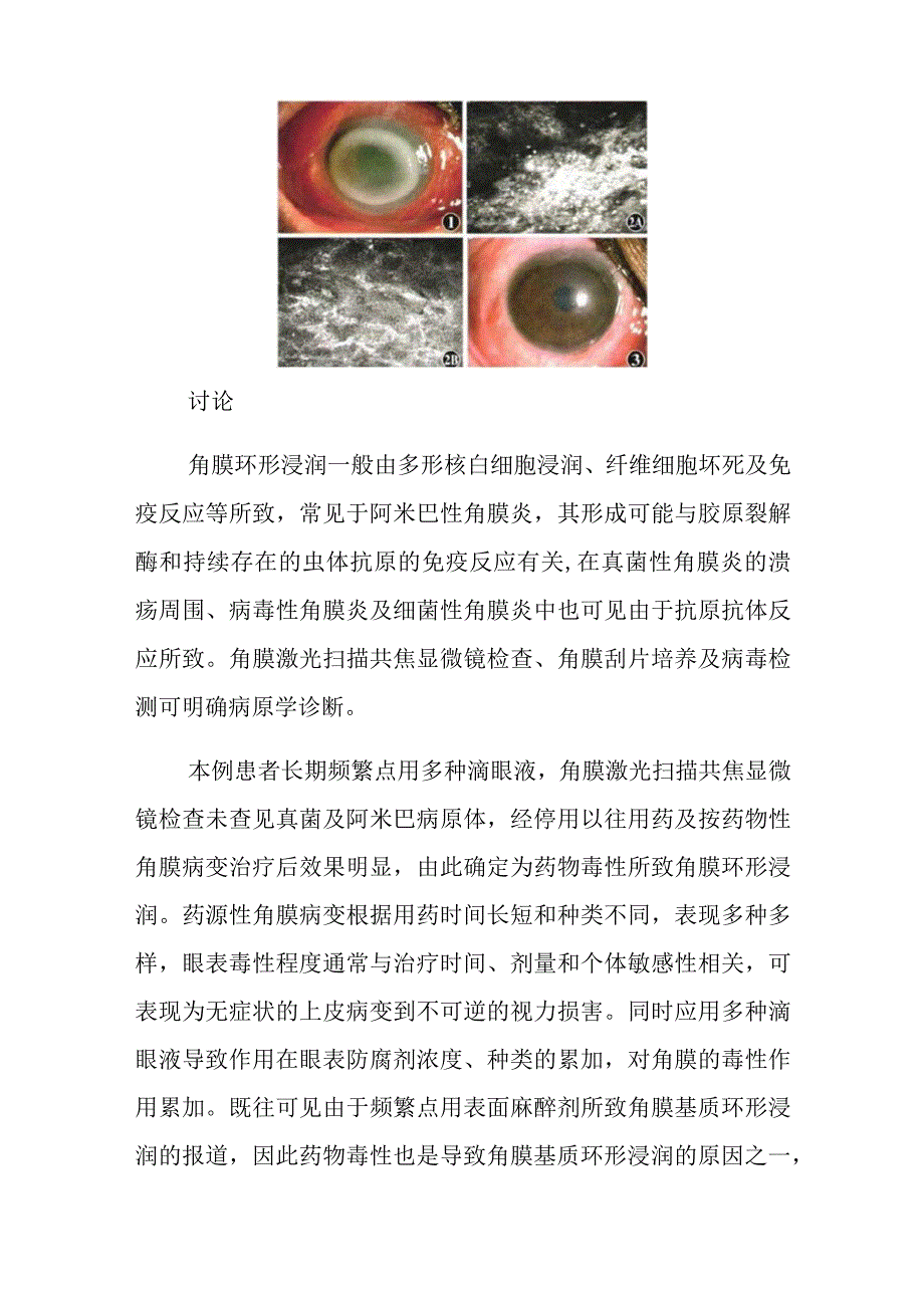 眼科一例药物性角膜环形浸润病例分析专题报告.docx_第2页