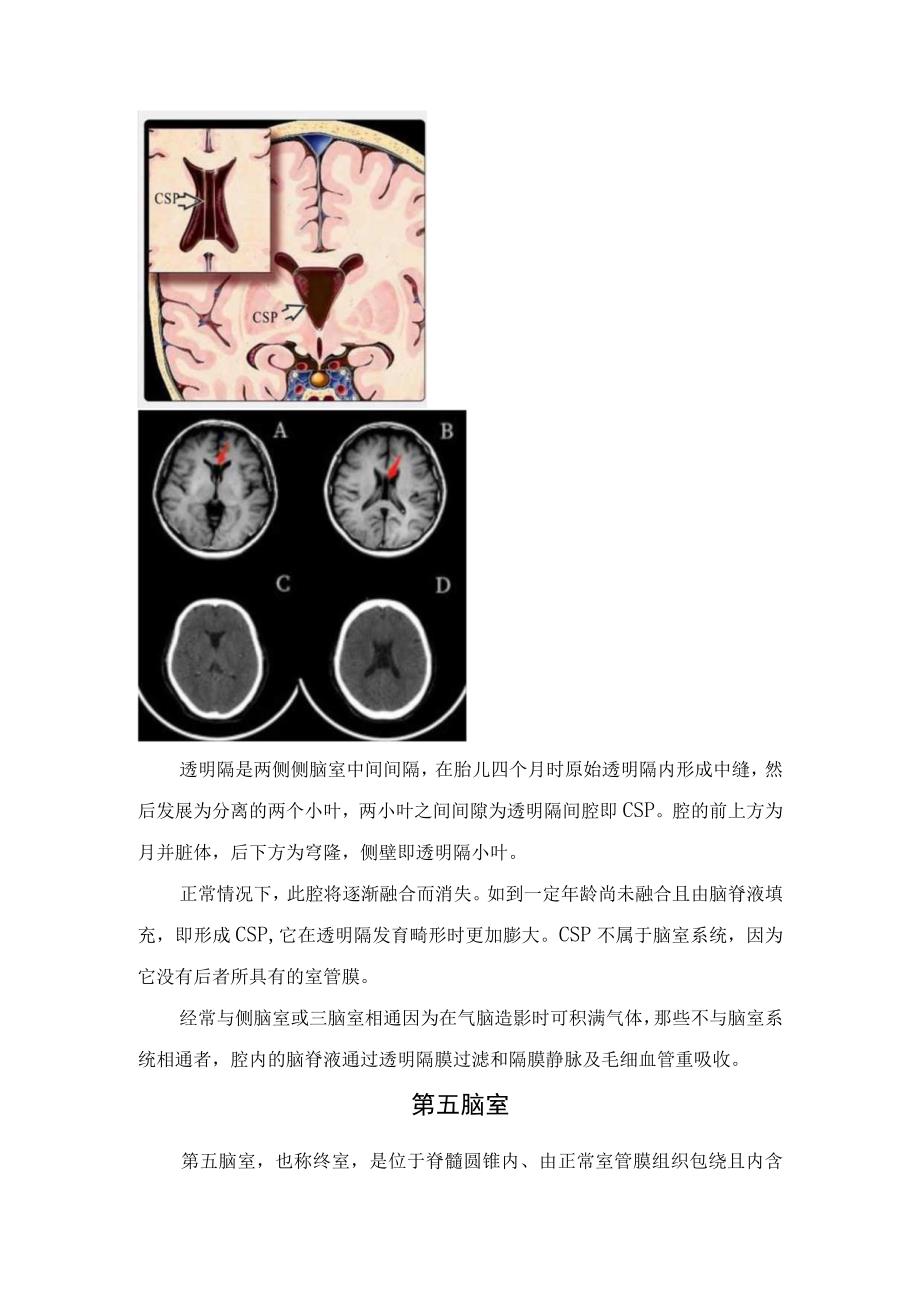 第五脑室结构部位位置影像学表现及鉴别诊断.docx_第2页