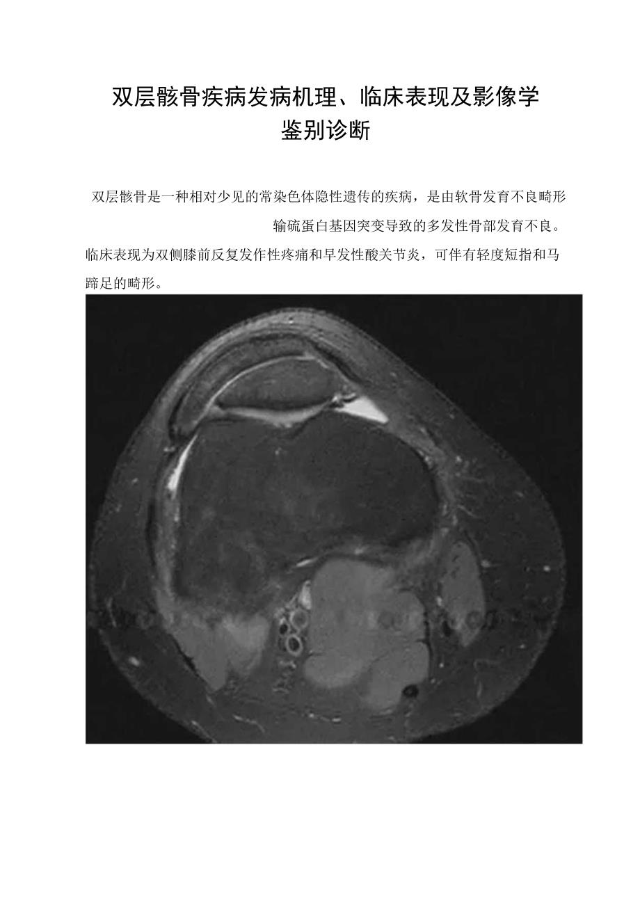 双层髌骨疾病发病机理、临床表现及影像学鉴别诊断.docx_第1页