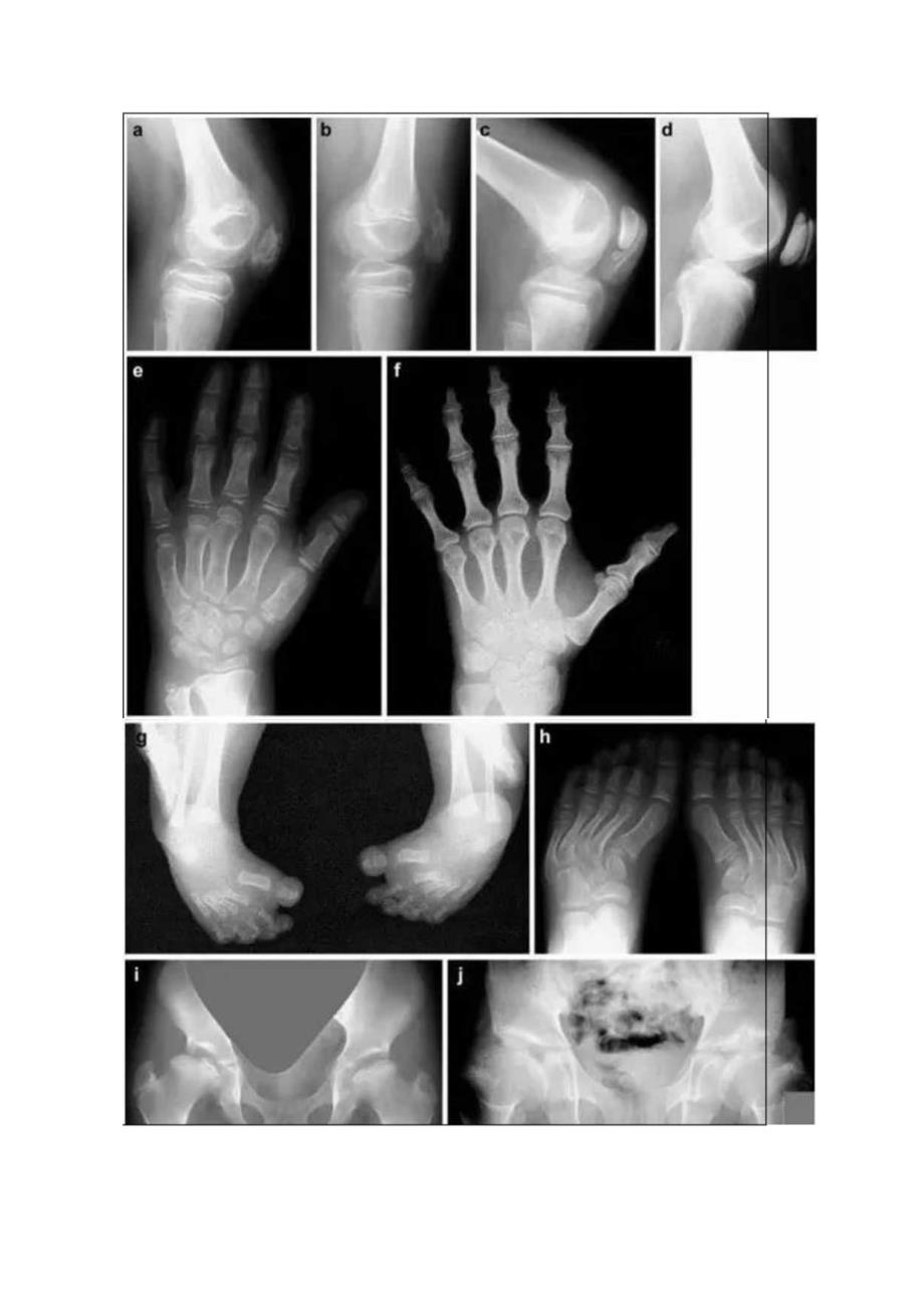 双层髌骨疾病发病机理、临床表现及影像学鉴别诊断.docx_第3页