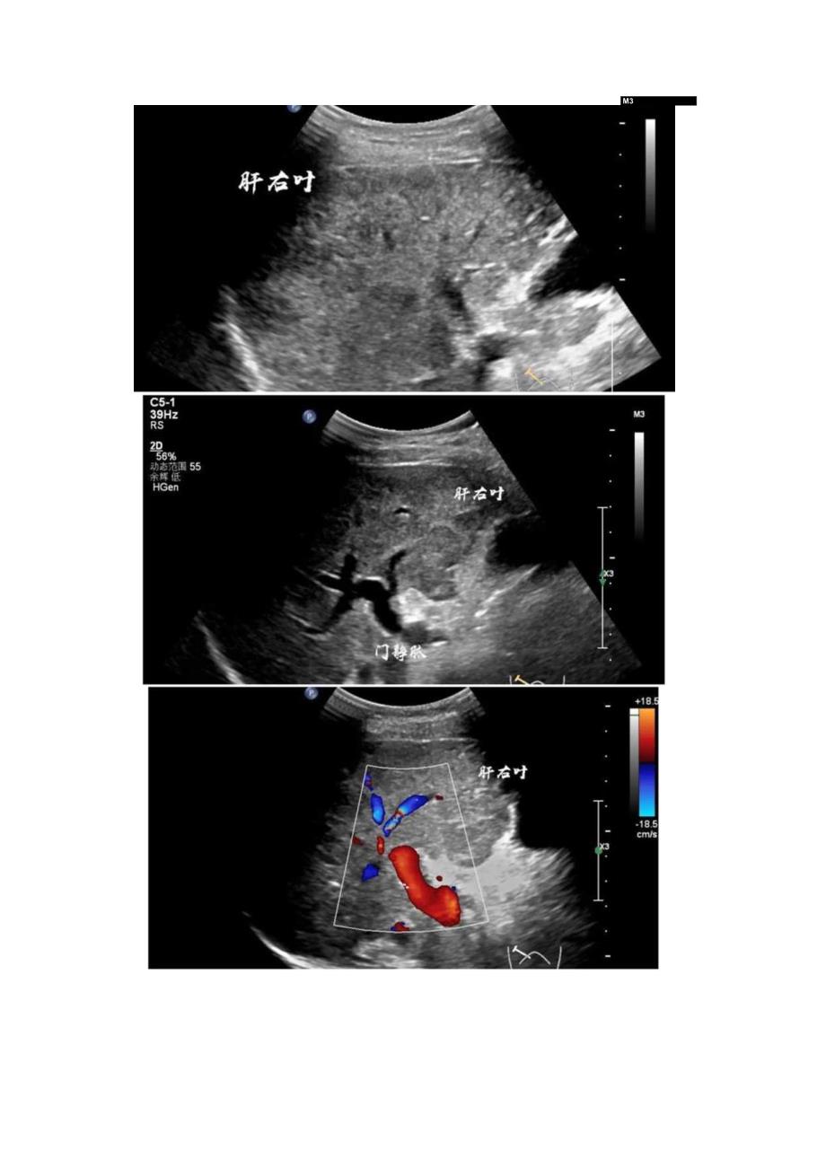 临床豆状核变性肝脏超声病例分享临床表现分型表现及影像学表现.docx_第3页