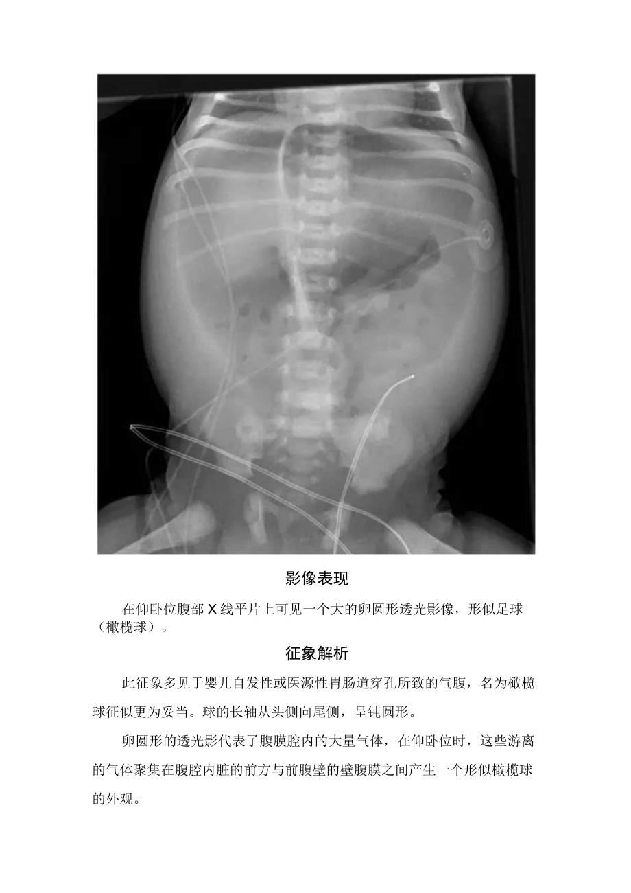 临床足球征病例分析影像学表现征象解析.docx_第2页