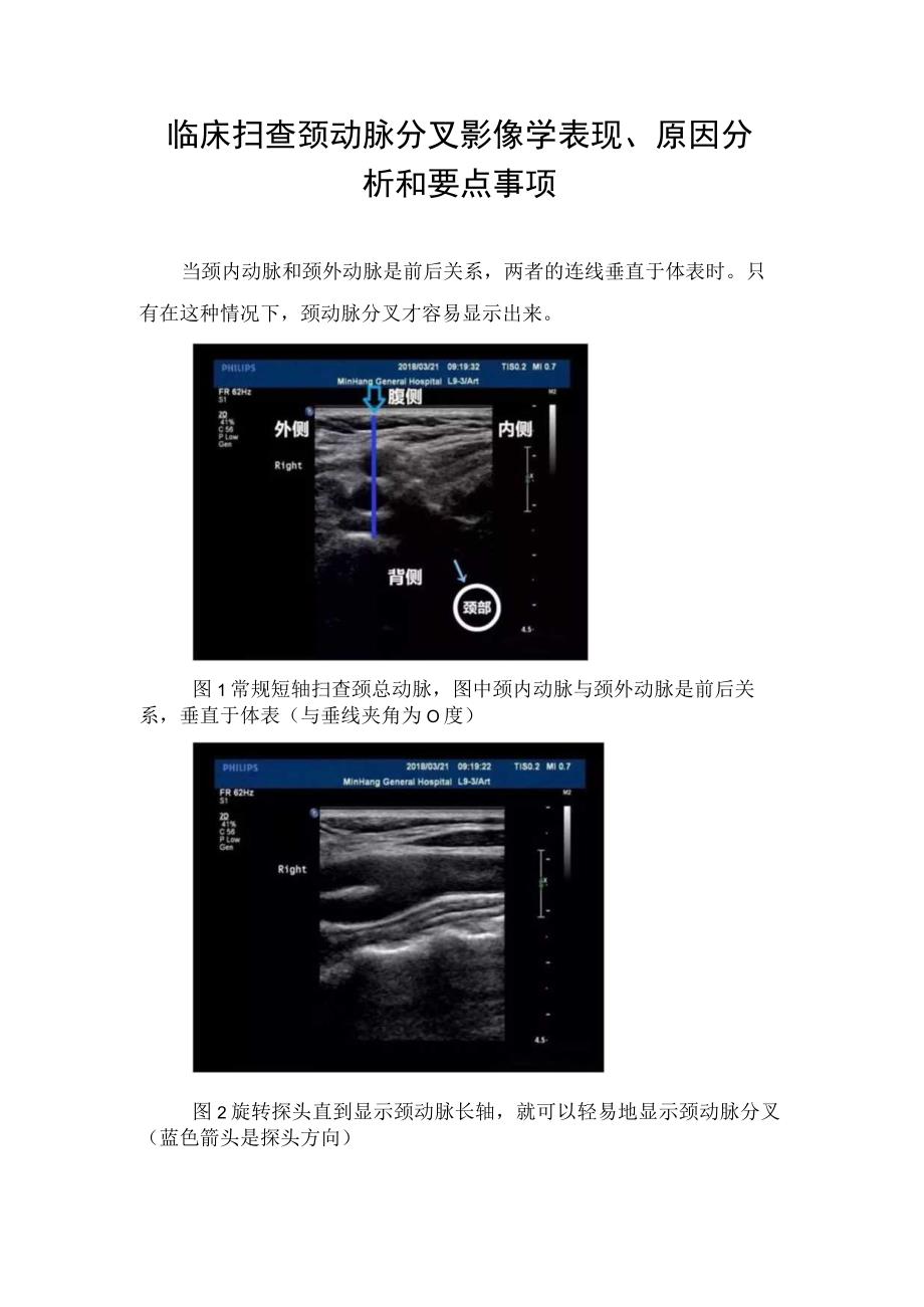 临床扫查颈动脉分叉影像学表现原因分析和注意要点.docx_第1页