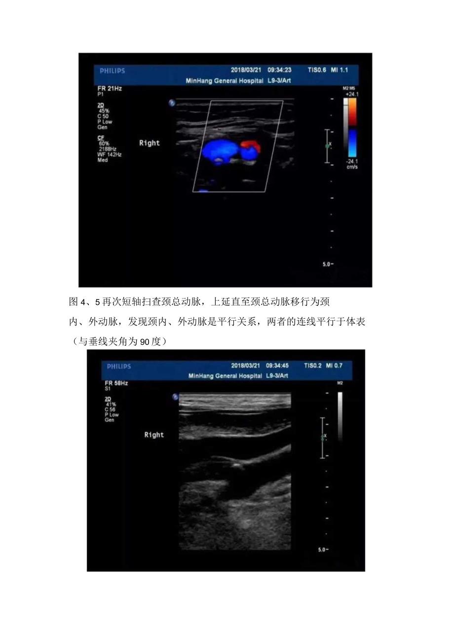 临床扫查颈动脉分叉影像学表现原因分析和注意要点.docx_第3页