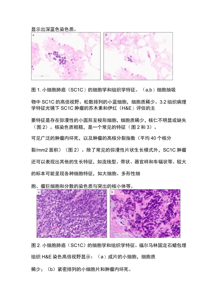 2023小细胞肺癌病理诊断要点.docx_第3页