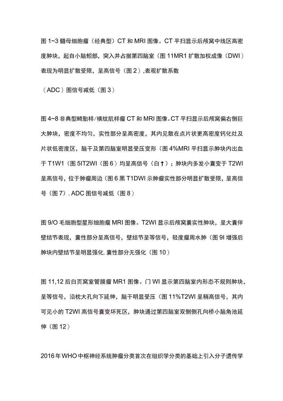 2023儿童后颅窝肿瘤的影像学诊断思路.docx_第3页