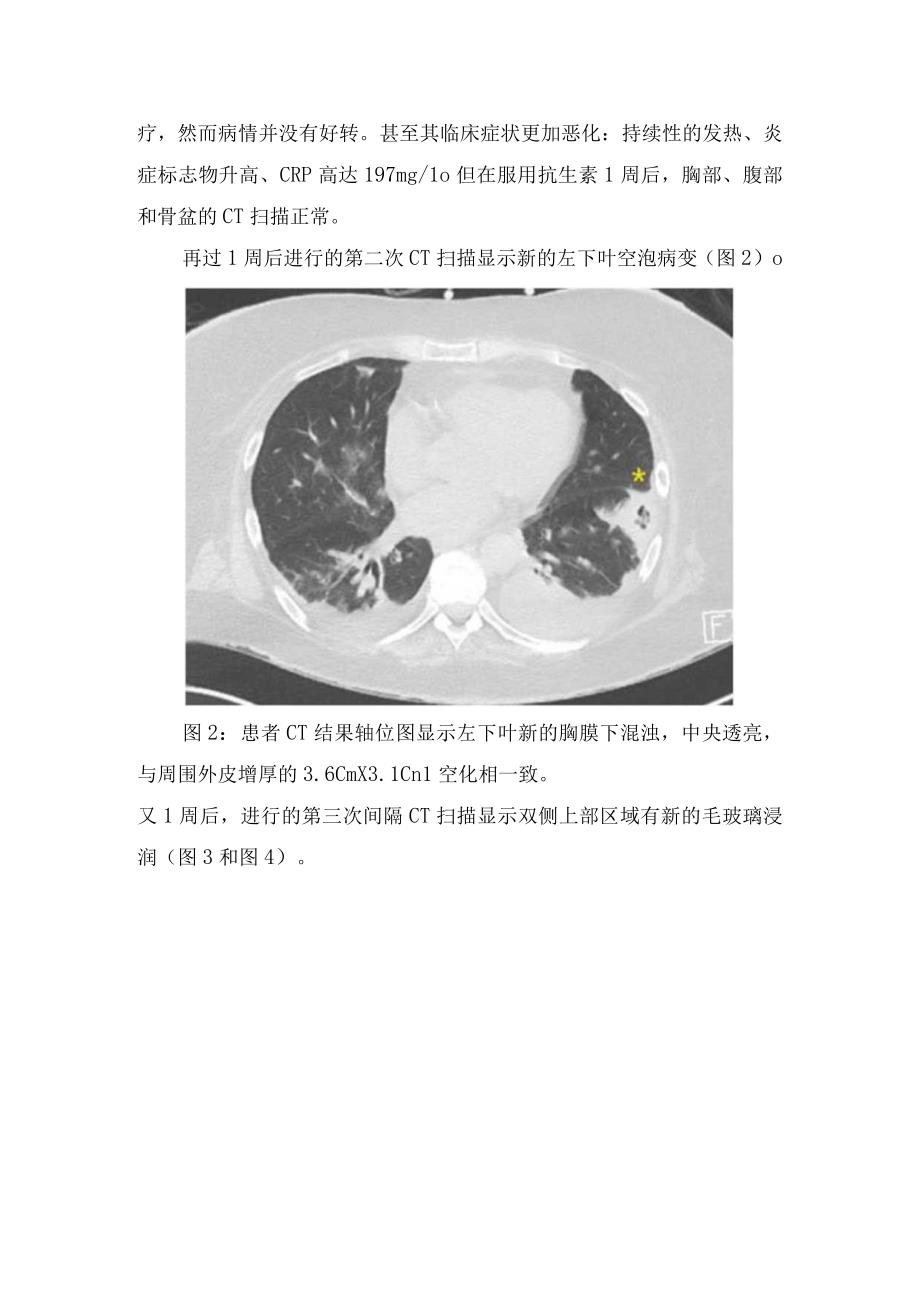 临床冷球蛋白血症病例分享发病机制分类临床表现和要点总结.docx_第2页