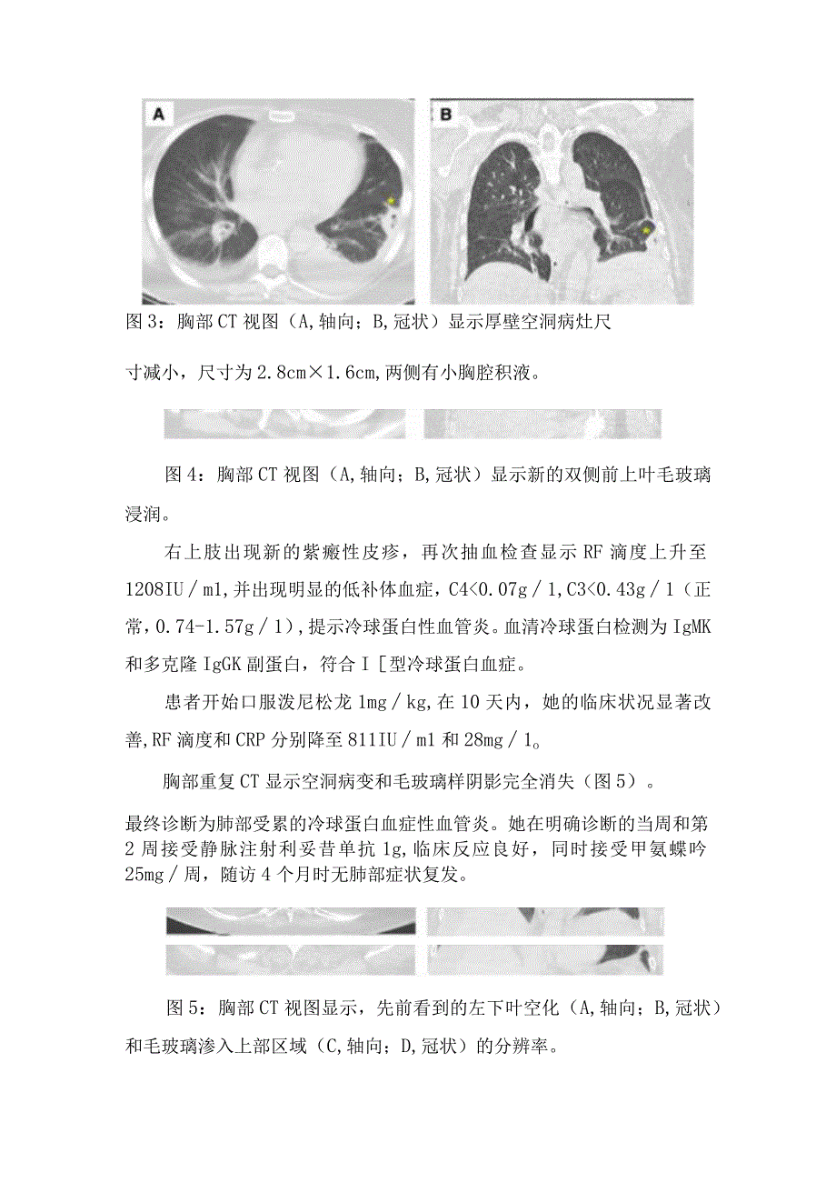 临床冷球蛋白血症病例分享发病机制分类临床表现和要点总结.docx_第3页