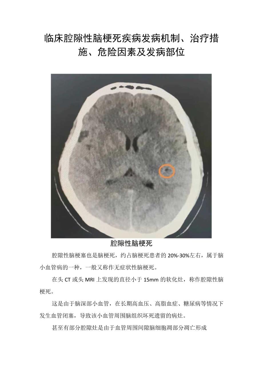 临床腔隙性脑梗死疾病发病机制治疗措施危险因素及发病部位.docx_第1页