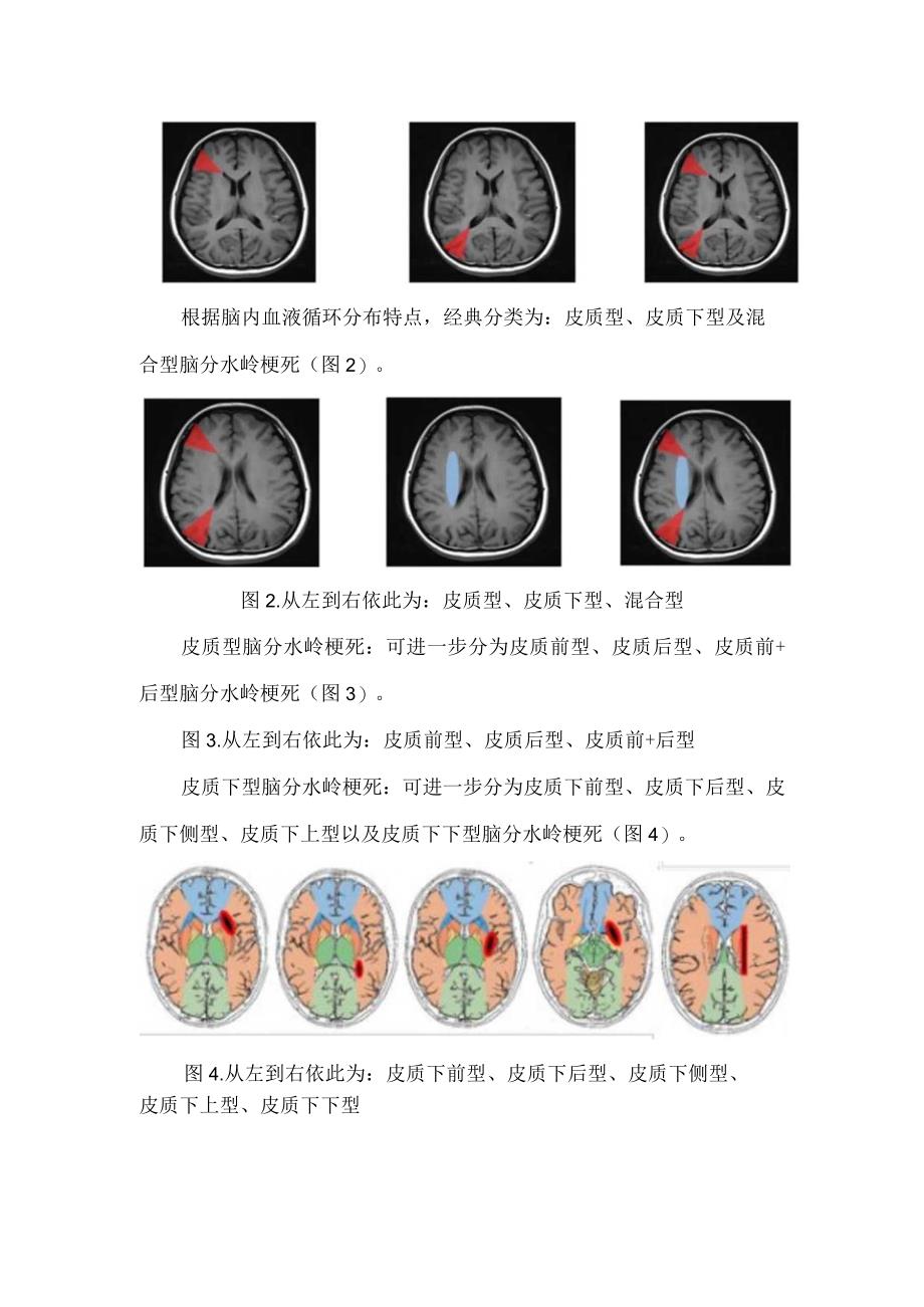 临床分水岭梗死发病机制病因影像表现大脑半球分水岭梗死分型案例分析及区分内外分水岭要点总结.docx_第3页