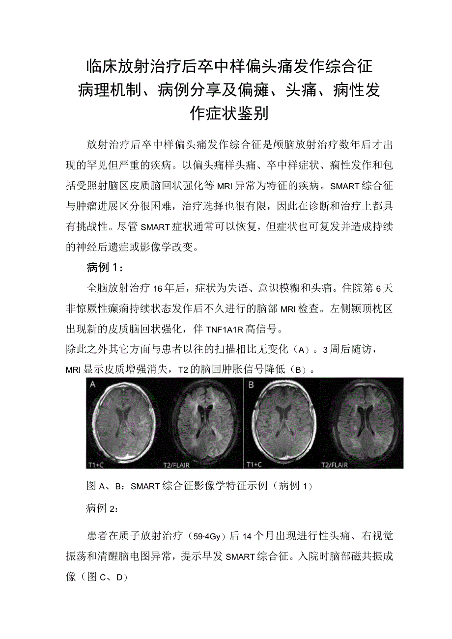 临床放射治疗后卒中样偏头痛发作综合征病理机制病例分享及偏瘫头痛痫性发作症状鉴别.docx_第1页