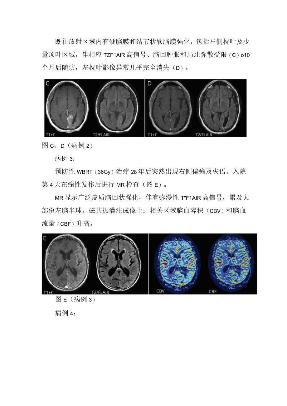 临床放射治疗后卒中样偏头痛发作综合征病理机制病例分享及偏瘫头痛痫性发作症状鉴别.docx_第2页