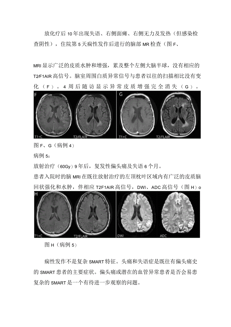 临床放射治疗后卒中样偏头痛发作综合征病理机制病例分享及偏瘫头痛痫性发作症状鉴别.docx_第3页