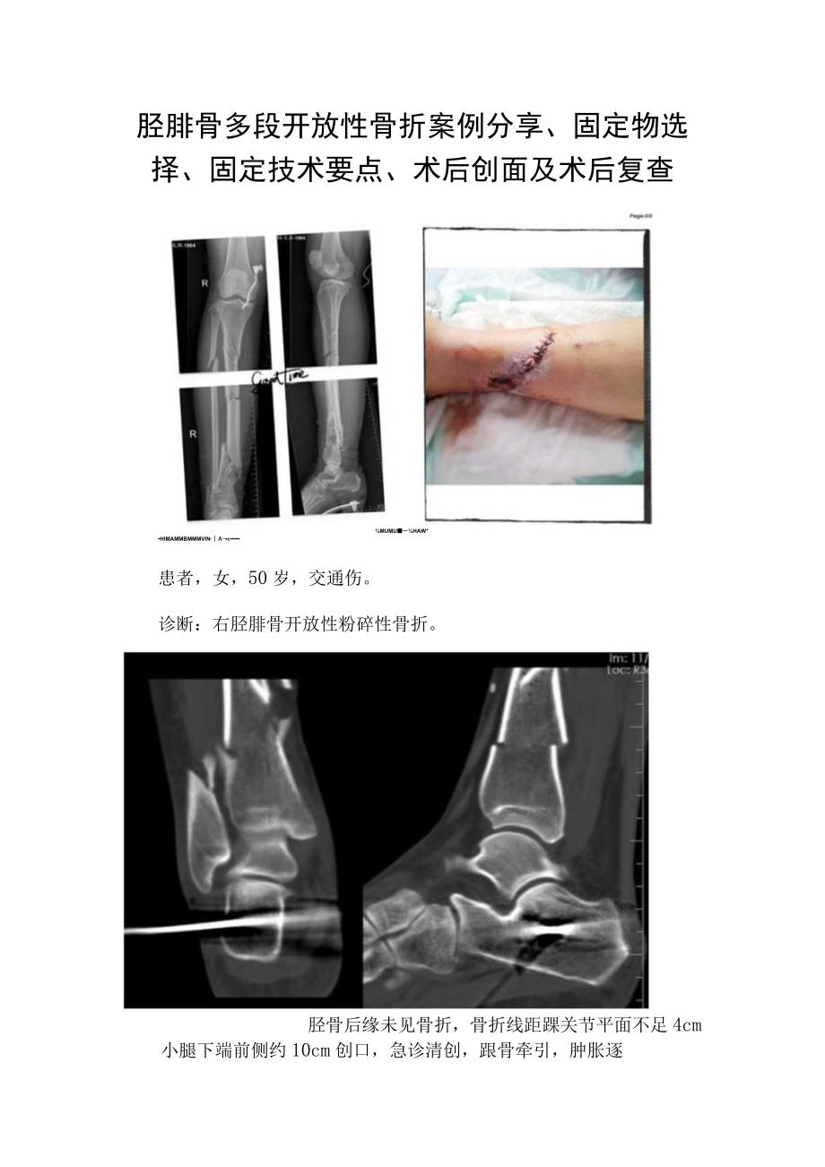 胫腓骨多段开放性骨折案例分享固定物选择固定技术要点术后创面及术后复查.docx_第1页