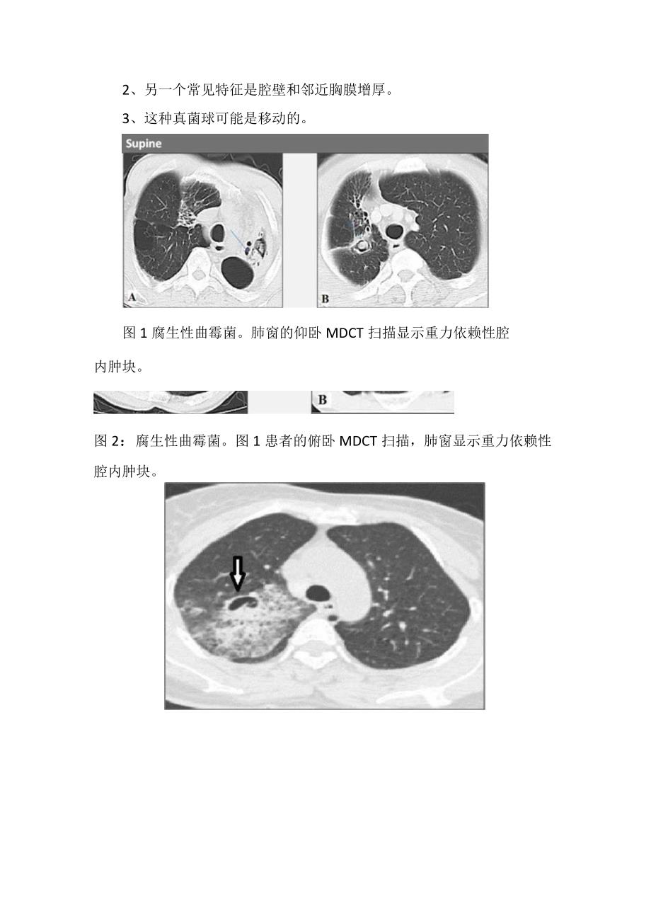 曲霉菌过敏性支气管肺曲霉菌病慢性坏死性肺曲霉菌病侵袭性曲霉菌病 侵袭性肺曲霉菌病等肺曲霉菌病发病机制临床表现和影像表现.docx_第2页