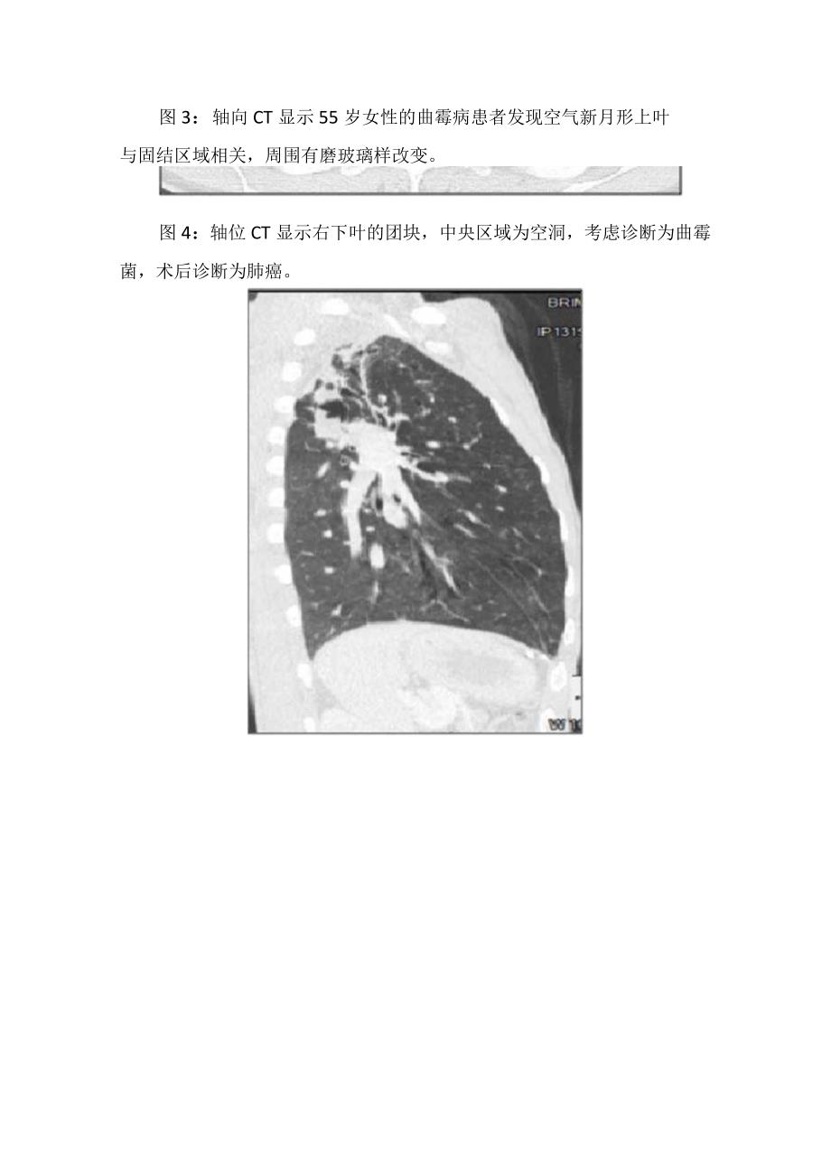 曲霉菌过敏性支气管肺曲霉菌病慢性坏死性肺曲霉菌病侵袭性曲霉菌病 侵袭性肺曲霉菌病等肺曲霉菌病发病机制临床表现和影像表现.docx_第3页