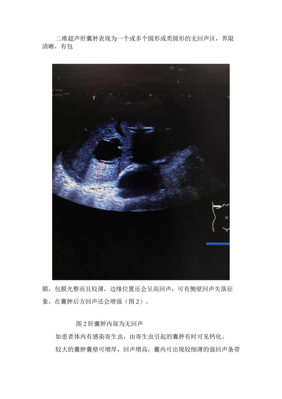 肝囊肿疾病分类超声表现和鉴别诊断.docx_第2页