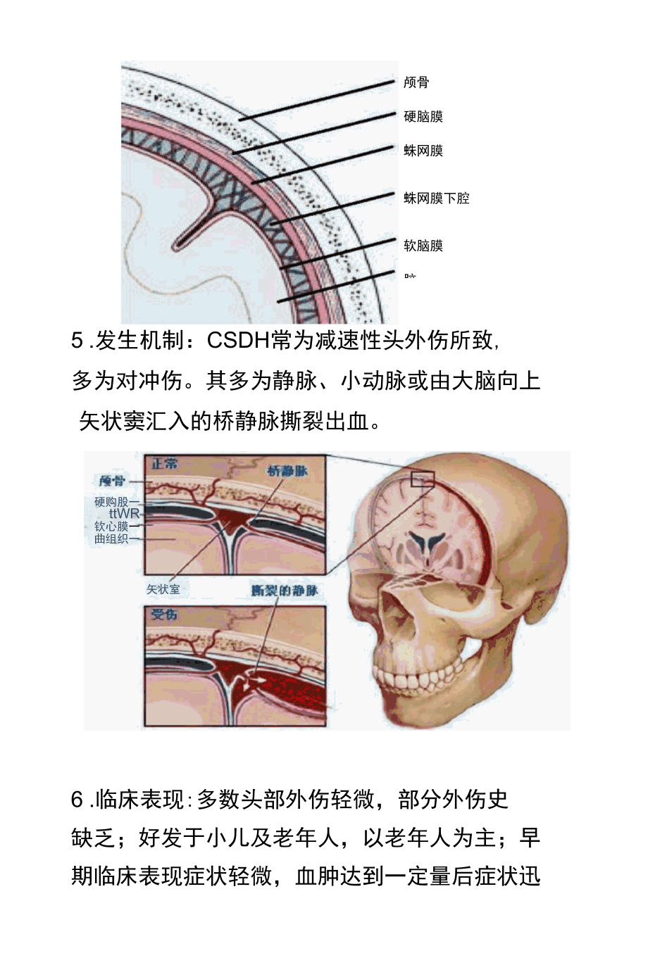 CSDH慢性硬膜下血肿的影像学诊断与鉴别诊断.docx_第3页