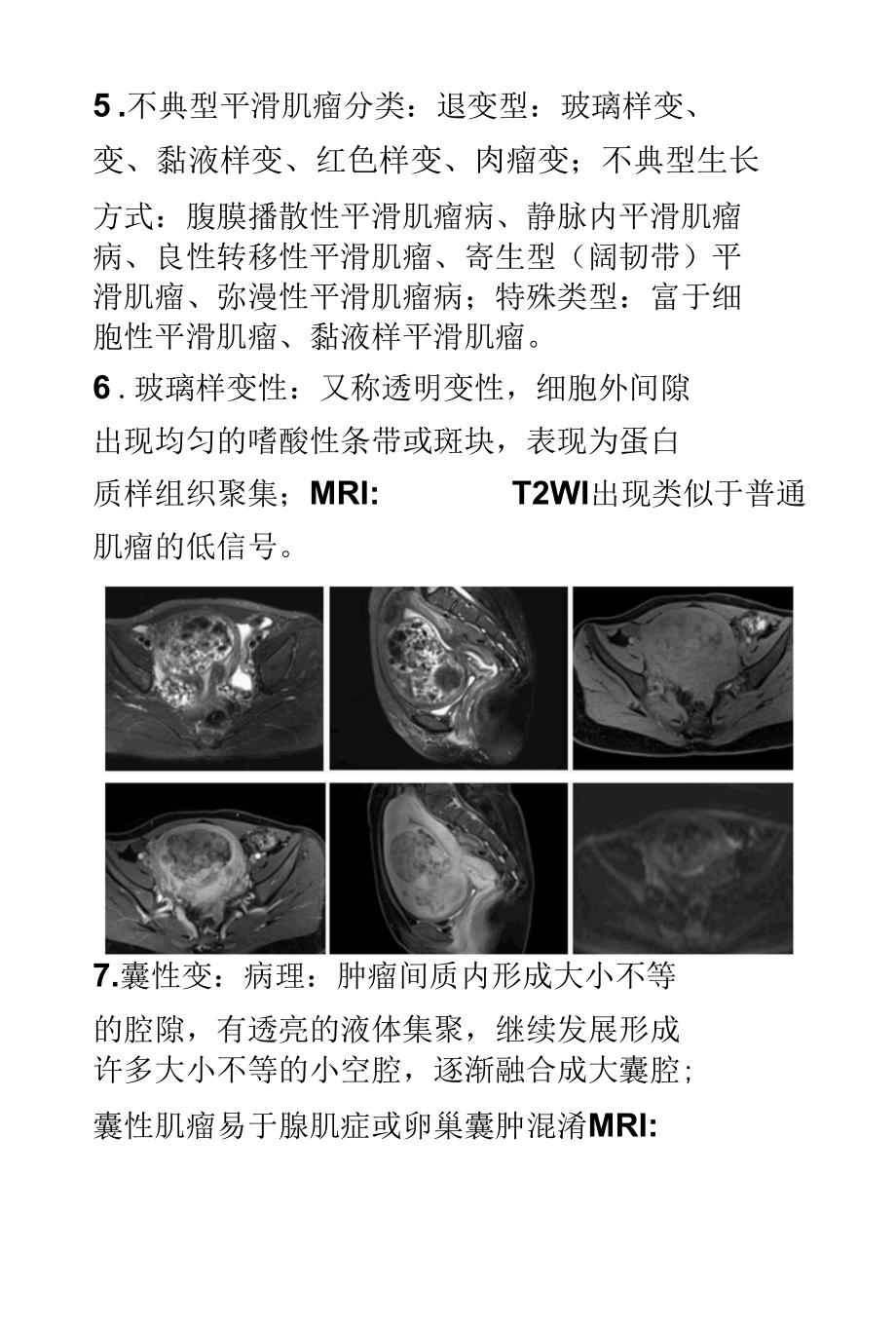 不典型子宫平滑肌瘤MRI影像.docx_第3页