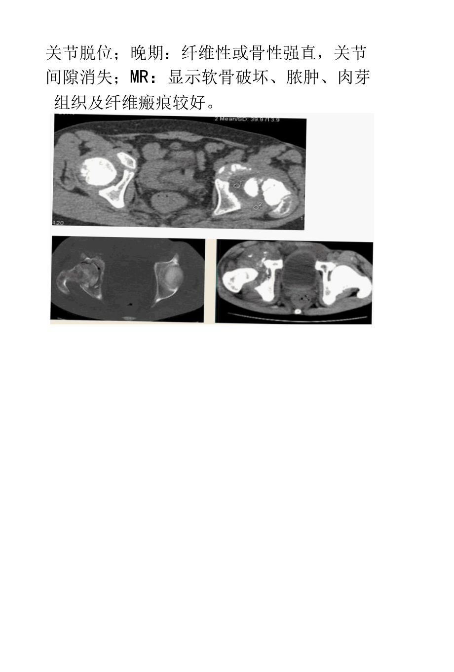 化脓性关节炎影像诊断.docx_第3页