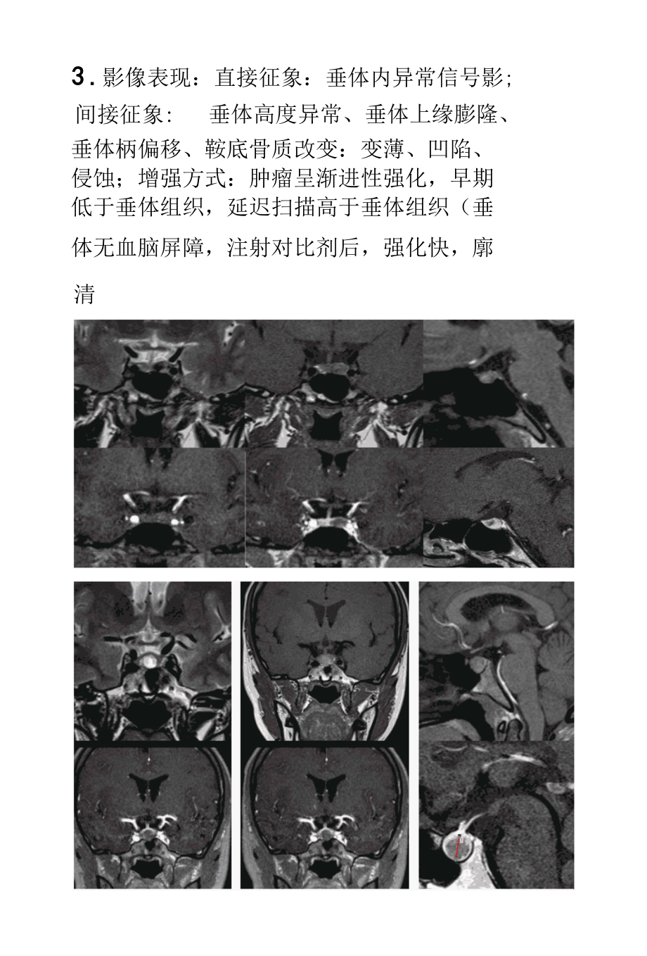 垂体微腺瘤影像诊断.docx_第2页