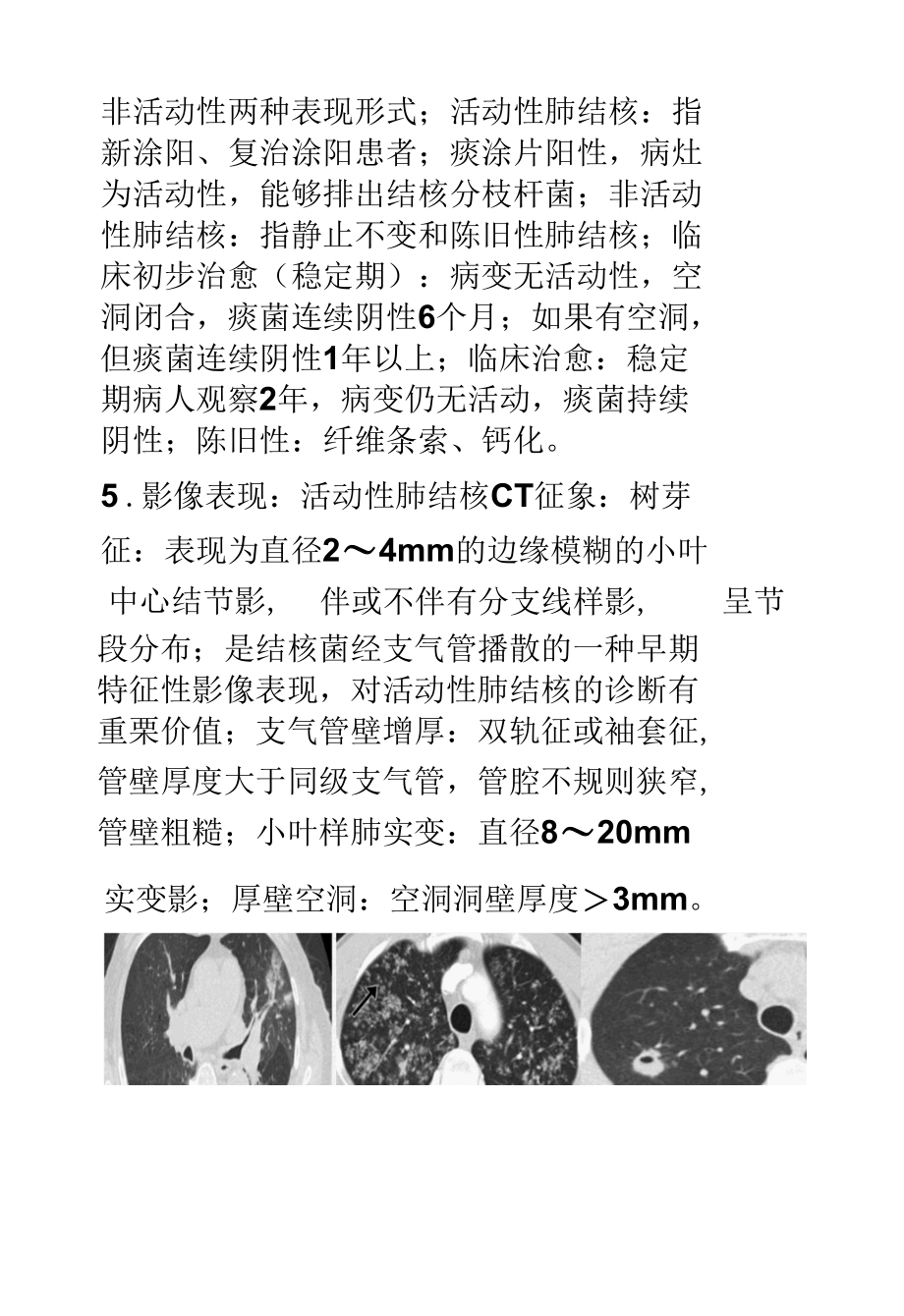 粟粒型肺结核与浸润型肺结核的影像诊断及鉴别诊断.docx_第3页