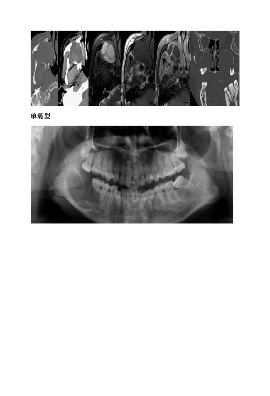 造釉细胞瘤影像诊断 (1).docx_第3页