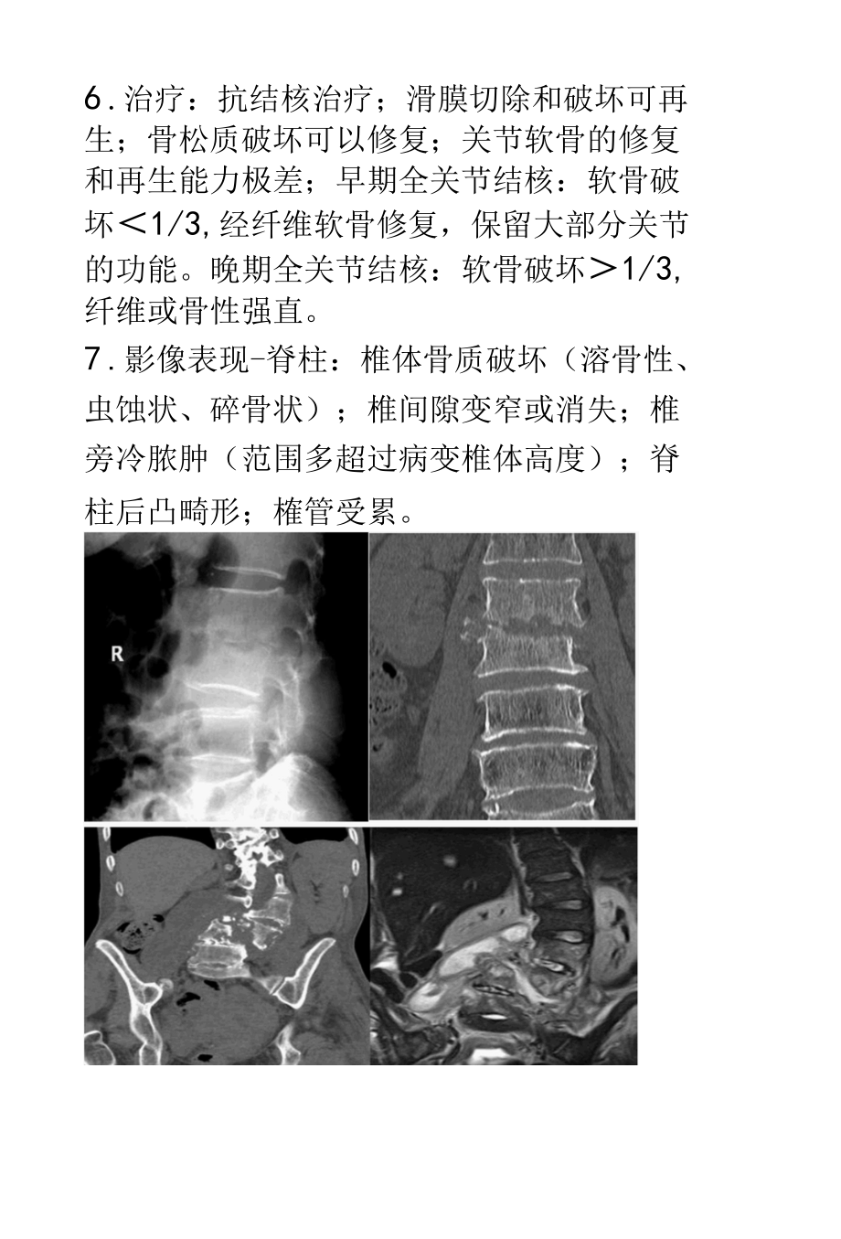 骨关节结核的影像诊断及鉴别诊断.docx_第2页