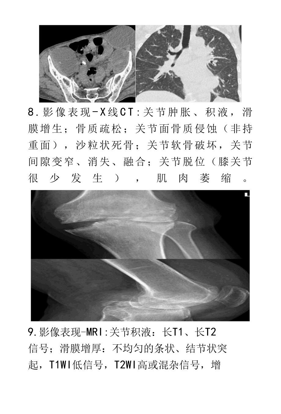 骨关节结核的影像诊断及鉴别诊断.docx_第3页