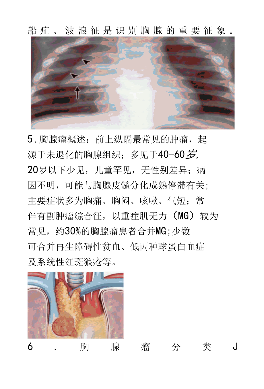 胸腺增生与胸腺瘤的影像诊断及鉴别诊断.docx_第3页