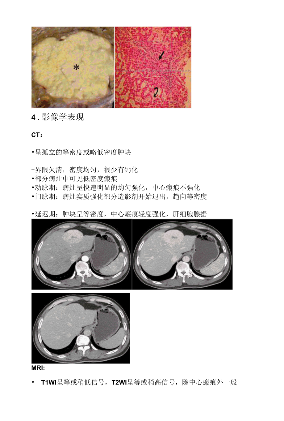 肝脏局灶性结节性增生影像学诊断.docx_第3页