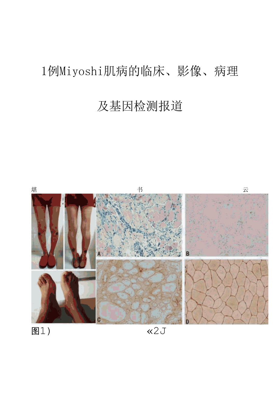 1例Miyoshi肌病的临床、影像、病理及基因检测报道.docx_第1页