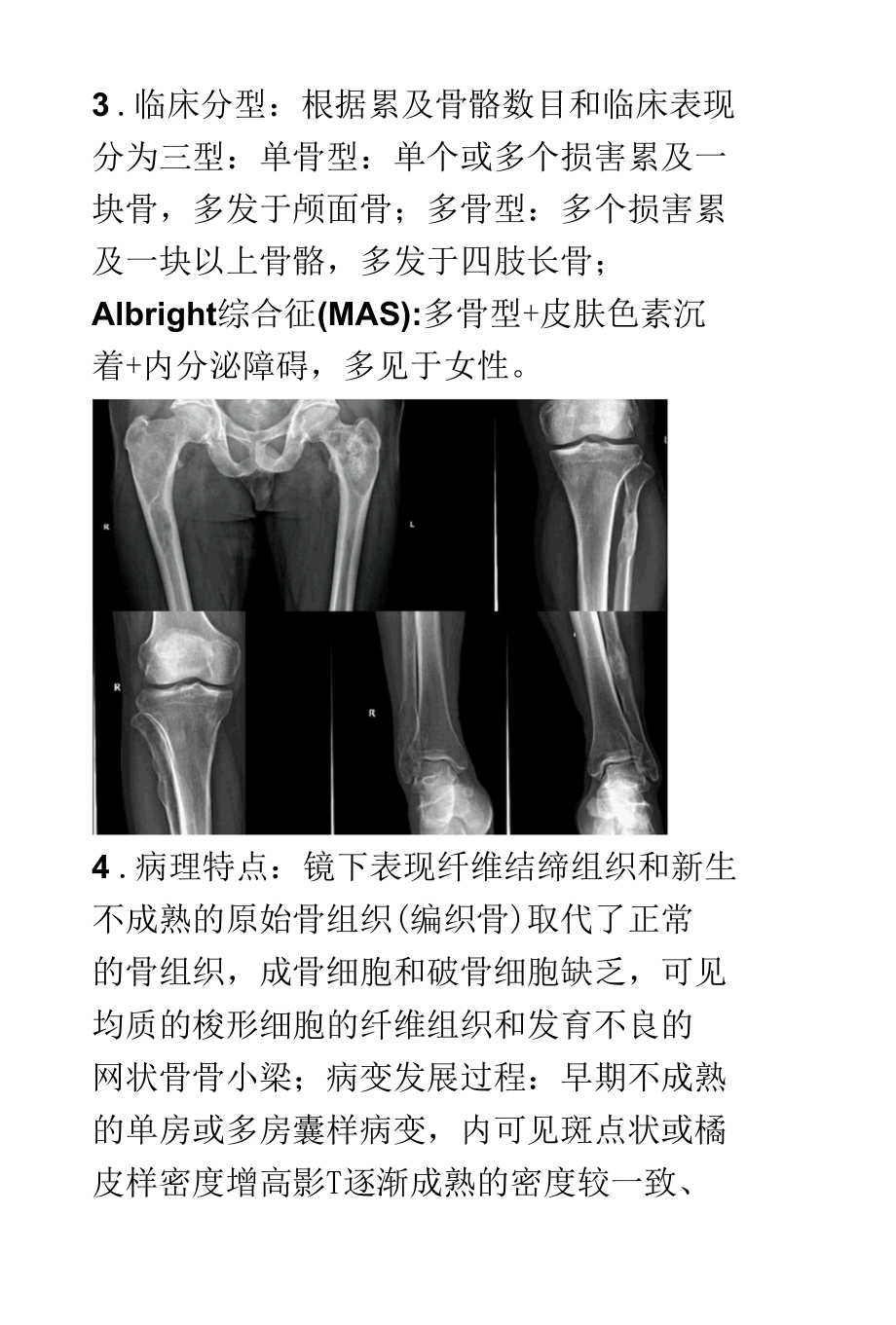 骨纤维异常增殖症FDB的影像诊断及鉴别诊断.docx_第2页