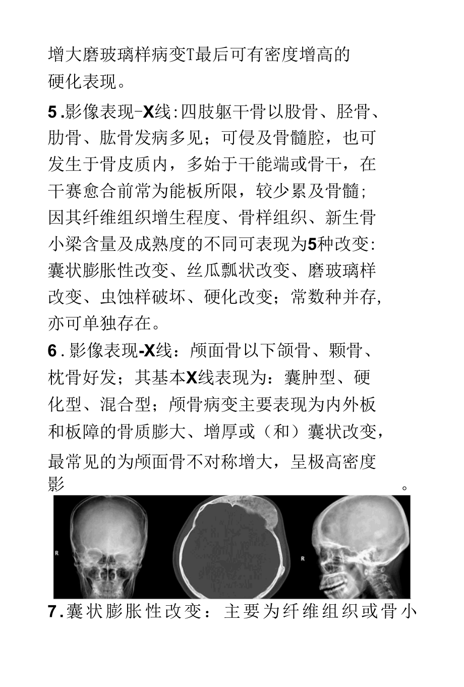 骨纤维异常增殖症FDB的影像诊断及鉴别诊断.docx_第3页